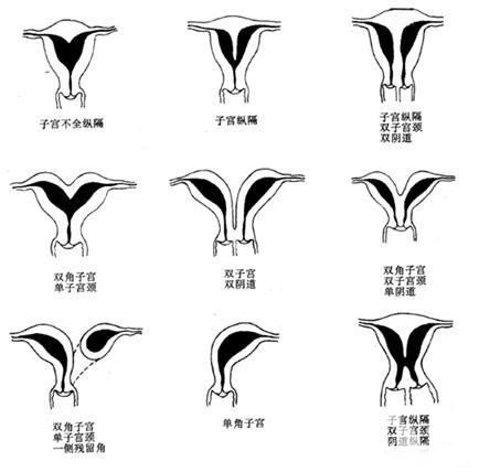 子宮畸形患者可以做試管嬰兒嗎？