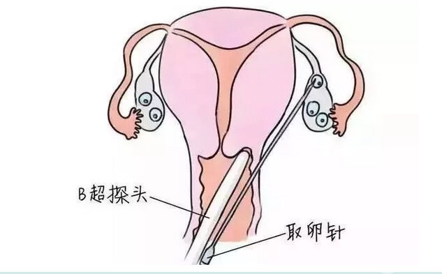 做試管嬰兒時，取卵越多越好嗎？