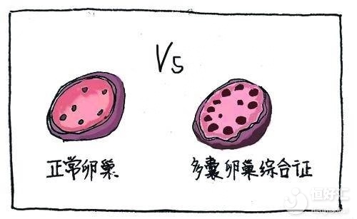 患上多囊卵巢綜合征，會發(fā)生什么變化呢？